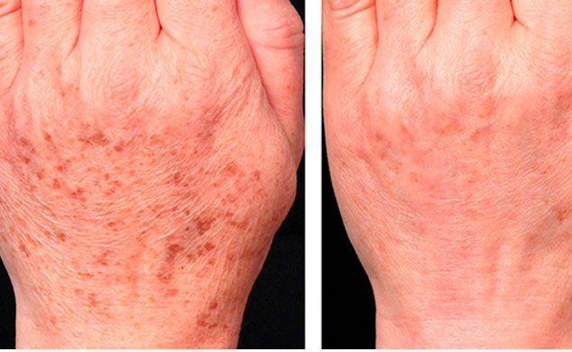 Гиперпигментация рук: до и после лечения