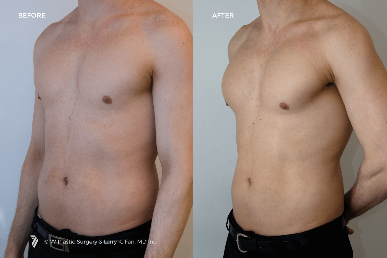 Грудные имплантаты у мужчин: до и после